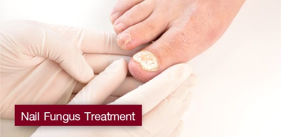 Nail Fungus Treatment